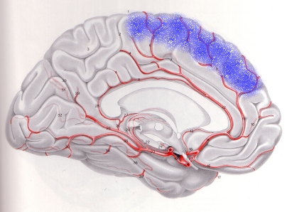  thrombosis of the superior sagittal sinus or ischemia in the territory 